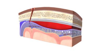 Dura mater ve araknoid madde arasında toplanan kana subdural hematom denir. 3B görüntüleme