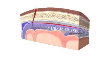 Dura mater ve araknoid madde arasında toplanan kana subdural hematom denir. 3B görüntüleme