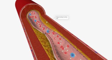 Hiperkolesterolemi, kan dolaşımındaki ortalama kolesterol seviyesinin üzerinde bir hastalıktır. 3B Hazırlama