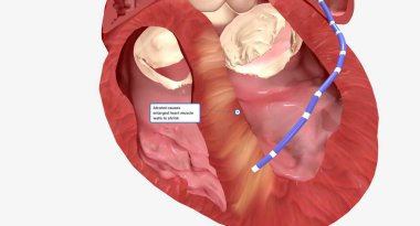 Bu, kalp dokusunun bir kısmının küçülmesine ve ölmesine neden olur. Kalan yara dokusu genişlemiş septumdan daha ince. 3B görüntüleme