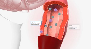 High volumes of lymphocytes, macrophages, and other immune cells infiltrate the inflamed aorta. 3D rendering