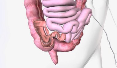 Intussusception, bağırsağın kendine doğru çekilen kısmından kaynaklanır. 3B Hazırlama