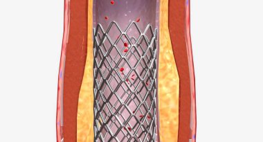 Gelecekte tıkanıklığı önlemek için stent takılabilir. 3B görüntüleme