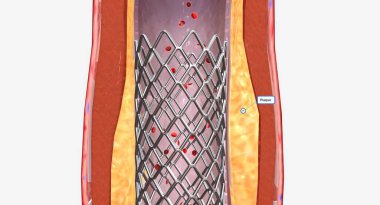 Gelecekte tıkanıklığı önlemek için stent takılabilir. 3B görüntüleme