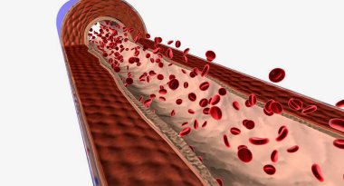 Pulmoner hipertansiyon akciğer atardamarlarındaki yüksek kan basıncıyla karakterize edilen bir kardiyovasküler durumdur..