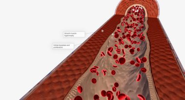 Pulmoner hipertansiyon akciğer atardamarlarındaki yüksek kan basıncıyla karakterize edilen bir kardiyovasküler durumdur..