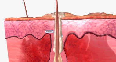 Hidradenitis suppurativa, saç foliküllerinin şişmesiyle karakterize edilen uzun vadeli bir cilt hastalığıdır. 3B görüntüleme
