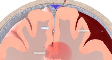 Beyin fıtığının yaygın bir türü dura 'nın orta kıvrımının (falx serebri) altında hareket eden beyin dokusuyla karakterize edilir. Bu tiplere subfalcine beyin fıtığı denir. 3B görüntüleme