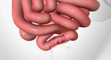 ileum 3 boyutlu görüntülemede B12 ve içsel faktör