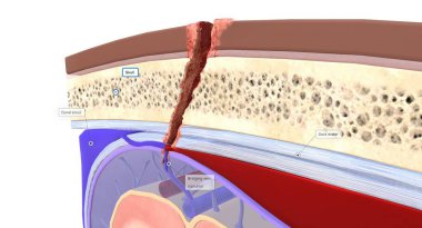 Dura mater ve araknoid madde arasında toplanan kana subdural hematom denir. 3B görüntüleme