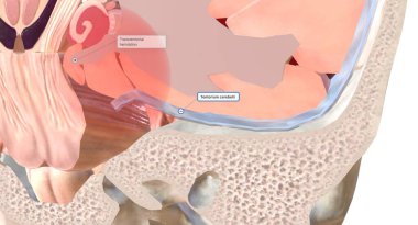 Beyin fıtığının yaygın bir türü dura 'nın orta kıvrımının (falx serebri) altında hareket eden beyin dokusuyla karakterize edilir. Bu tiplere subfalcine beyin fıtığı denir. 3B görüntüleme