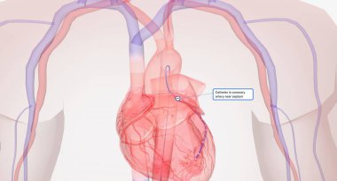 Önce bir kateter, ince bir tüp, bacağın büyük bir damarına yerleştirilir. Kateter anevrizma bölgesine yönlendirildi ve stent grefti sonda boyunca gönderilecek. 3B görüntüleme