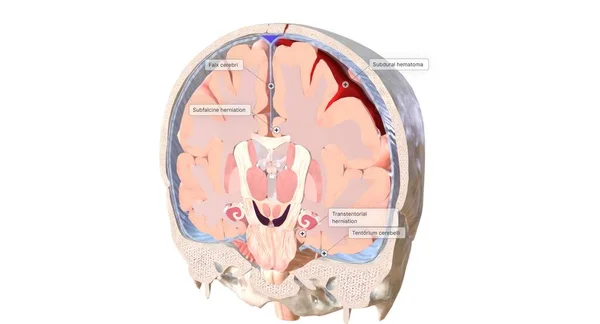 Один Распространенных Типов Грыжи Головного Мозга Характеризуется Ткани Головного Мозга — стоковое фото