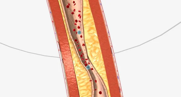 Atherosclerosis Plaque Buildup Walls Arteries Rendering — Foto Stock