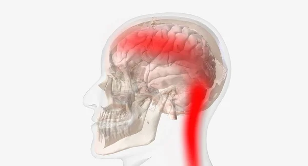 Bolesti Hlavy Známé Jako Typ Napětí Ovlivňují Čelo Spánky Zadní — Stock fotografie