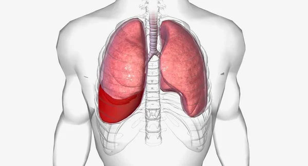 Hämothorax Ist Eine Lungenerkrankung Bei Der Sich Blut Die Lunge — Stockfoto