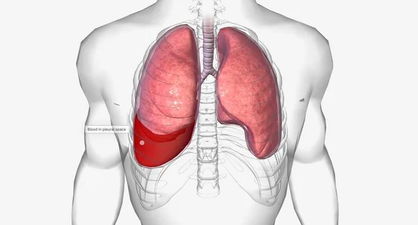 Hémothorax Est Une Affection Pulmonaire Dans Laquelle Sang Accumule Autour — Photo
