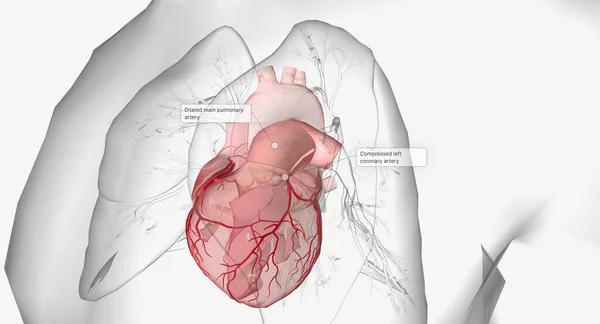 Dilatazione Idiopatica Dell Arteria Polmonare Idpa Una Rara Condizione Congenita — Foto Stock