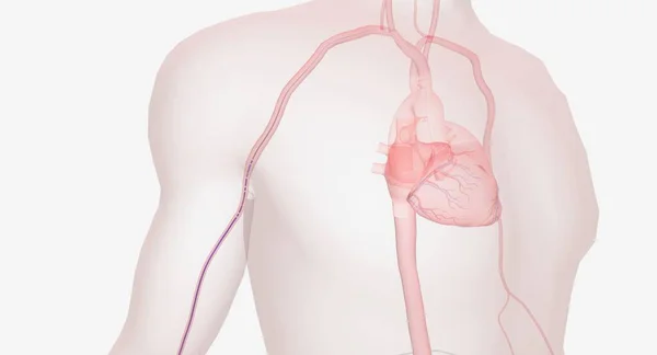 放射性動脈を通して心臓のカテーテル化では カテーテルは放射性動脈を通して前腕を継続します 3Dレンダリング — ストック写真