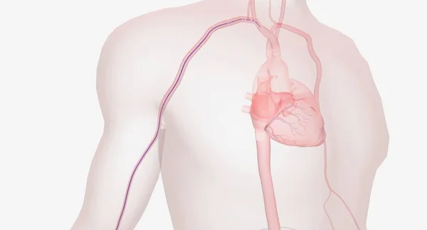 Cateterismo Cardíaco Través Arteria Radial Catéter Continúa Hasta Antebrazo Través —  Fotos de Stock