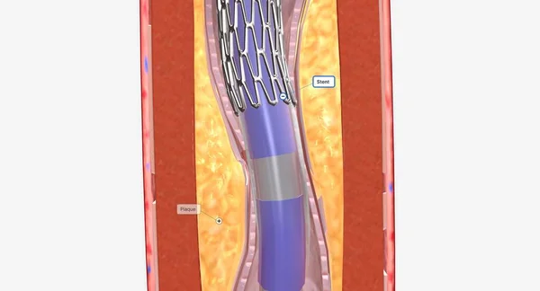 血管成形术是一种微创的手术 它使用带有气球尖的导管来扩张你堵塞的动脉 3D渲染 — 图库照片