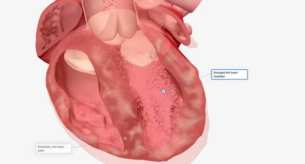 心力衰竭是一种持续的情况 可能需要几种药物来治疗多种症状 3D渲染 — 图库照片