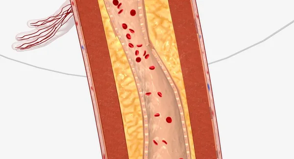 下肢狭窄的血管下肢动脉介入治疗可包括血管成形术 支架置换术或无神论者切除术 3D渲染 — 图库照片