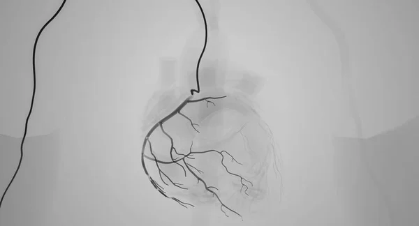 Catheter Tool Coronary Angiography Render — Stock Photo, Image