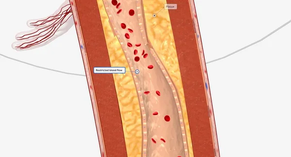 下肢の狭窄した血管低限動脈介入には血管形成術 ステント術 または切除術が含まれる場合があります 3Dレンダリング — ストック写真