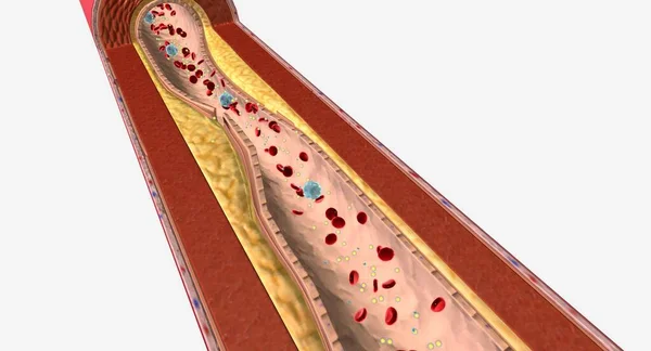 高甘油三酯血症是一种以血液中甘油三酯含量高为特征的常见病 3D渲染 — 图库照片