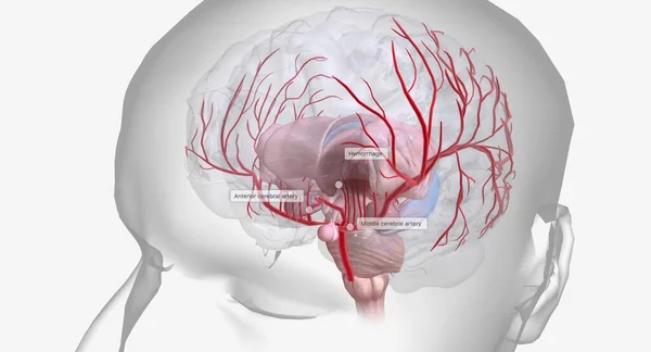 Геморрагический Инсульт Срочное Заболевание Характеризующееся Кровотечением Внутри Поверхности Мозга — стоковое фото