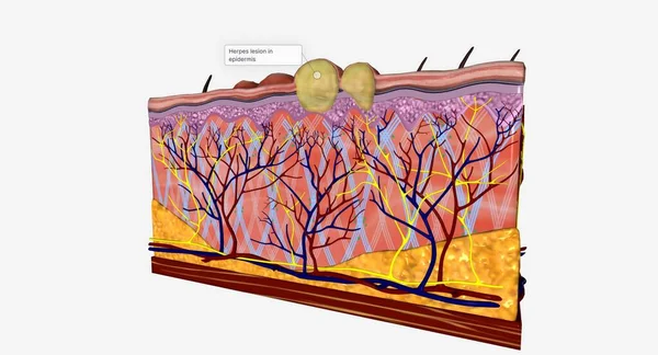 Herpes Lezyonları Arasında Çapraz Bölüm Üç Boyut Hazırlama