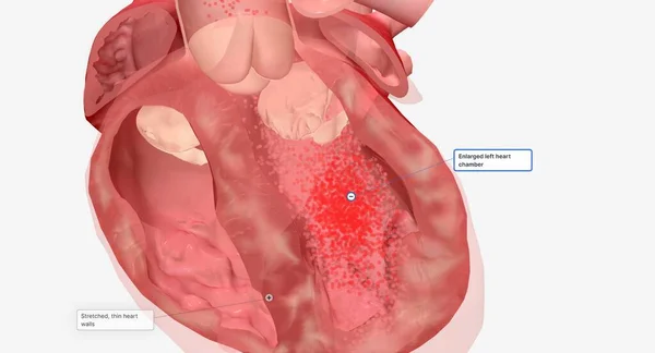 Heart failure is an ongoing condition that may need several medications to treat multiple symptoms. 3D Render