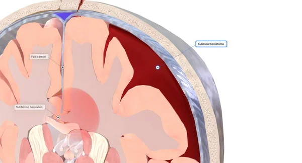 One Common Type Brain Herniation Characterized Brain Tissue Moving Middle — 스톡 사진