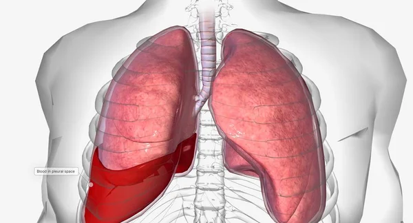 Emotorace Una Condizione Polmonare Cui Sangue Accumula Intorno Polmoni Rendering — Foto Stock