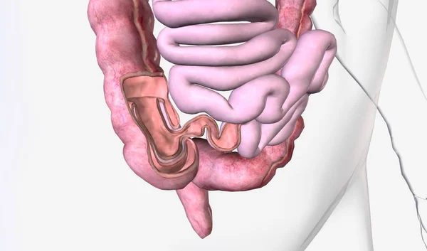 肠子的内陷是由于肠子的一部分被拉入自身而引起的 3D渲染 — 图库照片