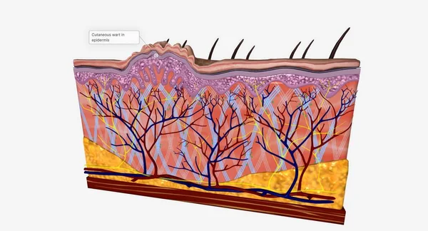 stock image Cutaneous warts affect the outermost layer of skin (epidermis). 3D rendering