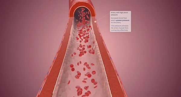 当血液对动脉壁的压力过高时 高血压会导致高血压 3D渲染 — 图库照片