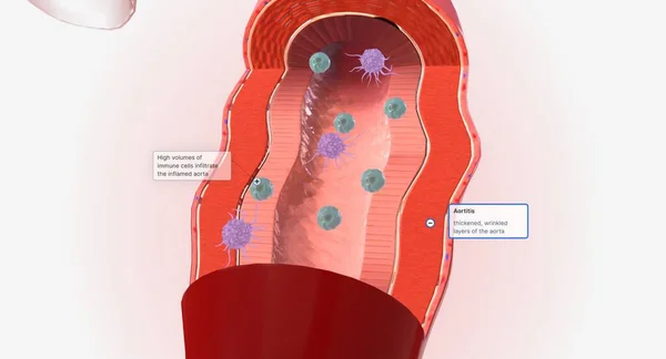 Высокие Объемы Лимфоцитов Макрофагов Других Иммунных Клеток Проникают Воспаленную Аорту — стоковое фото