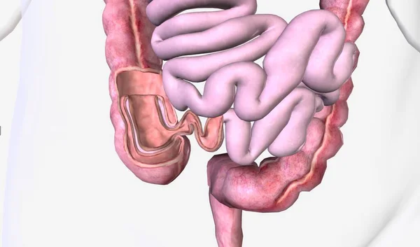 腸閉塞は腸の一部が内部に引っ張られることによって引き起こされます 3Dレンダリング — ストック写真