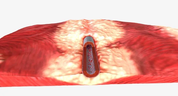 高钾是指血液中的钾水平高于某一水平 可能有许多不同的原因 3D渲染 — 图库照片