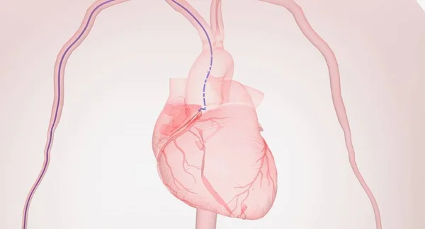 心臓の評価のためのツールとしてのカテーテル 3Dレンダリング — ストック写真
