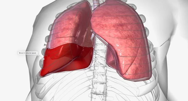 Emotorace Una Condizione Polmonare Cui Sangue Accumula Intorno Polmoni Rendering — Foto Stock