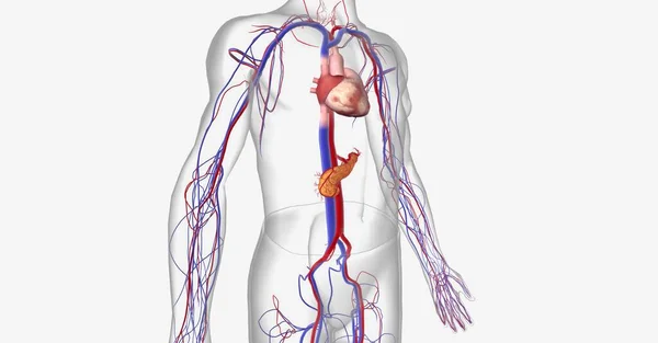 胰腺癌的分期取决于肿瘤的大小 淋巴结的参与和转移 到身体的其他部位 3D渲染 — 图库照片