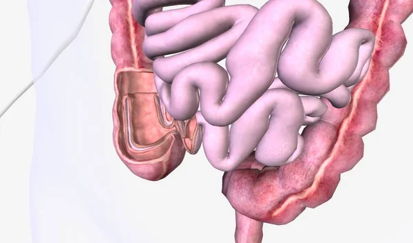 腸閉塞は腸の一部が内部に引っ張られることによって引き起こされます 3Dレンダリング — ストック写真
