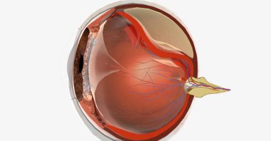 Retina yırtılması genellikle retinada küçük bir delik ya da yırtılmayla başlar. 3B görüntüleme
