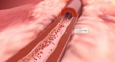 Angiotensin II reseptör blokörleri (ARB 'lar) atardamarların düz kas duvarlarını gevşetmeye yardımcı olur. Atardamar genişliyor, bu da kan basıncını düşürüyor. 3B görüntüleme