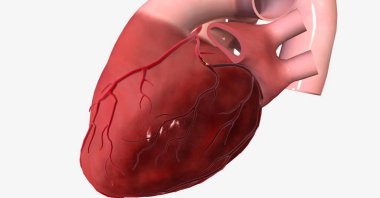 Myocardial infarction (heart attack) is a serious condition that occurs when blood and oxygen supply to the heart is reduced, causing part of the heart muscle to suddenly die. 3D rendering clipart
