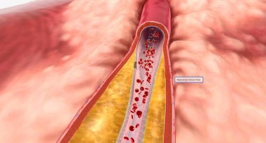 As hyperlipidemia continues over time, plaque may grow and restrict blood flow through an artery. 3D Render clipart