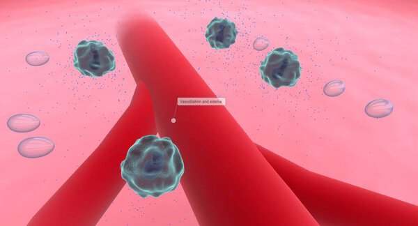 Anaphylaxis, Histamine Release and Vascular Edema. 3D rendering